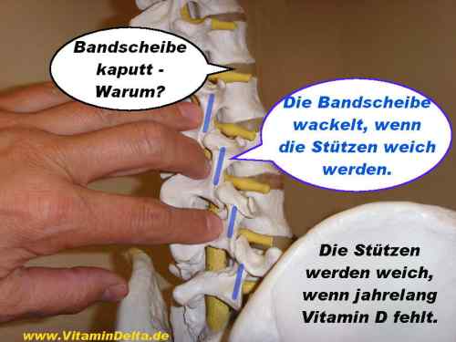 VitaminD-Bandscheibe-Rueckenschmerz-Spondylarthrose