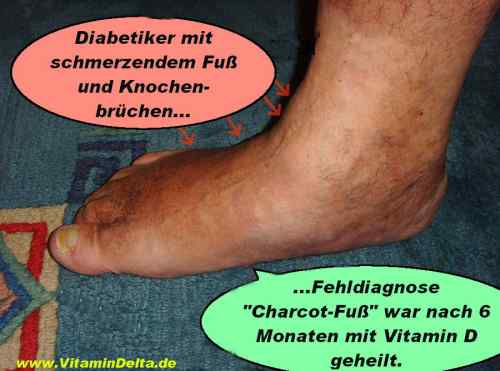 Folie086 Vitamin D Fußknochen Bruch